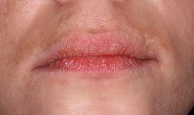 Dermal Lip Filler (Juvederm) case 71 — before