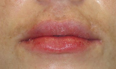 Dermal Lip Filler (Juvederm) case 71 — after