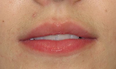 Dermal Lip Filler (Juvederm) case 86 — before