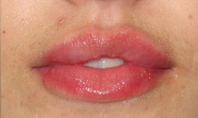 Dermal Lip Filler (Juvederm) case 86 — after