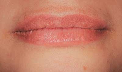 Dermal Lip Filler (Juvederm) case 92 — before
