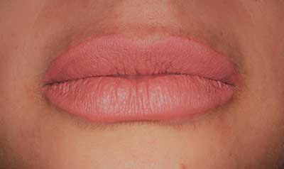 Dermal Lip Filler (Juvederm) case 92 — after