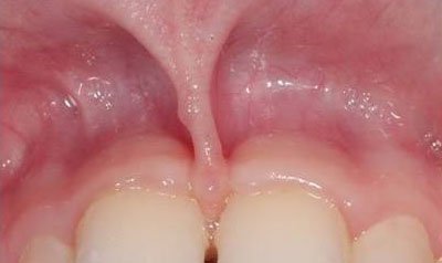 Frenectomy Cases case 67 — before