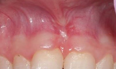 Frenectomy Cases