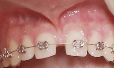Frenectomy Cases case 68 — before