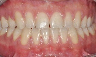 Frenectomy Cases case 68 — after