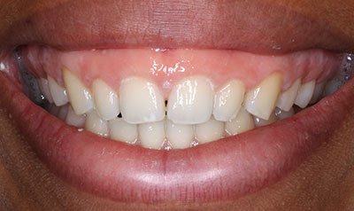 Gummy Smile Cases case 104 — before