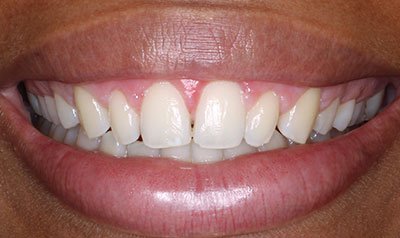 Gummy Smile Cases case 104 — after