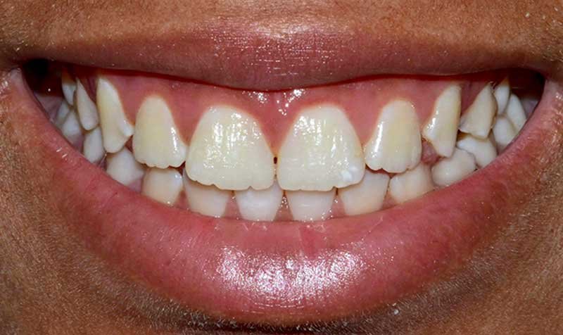 Gummy Smile Cases case 121 — before