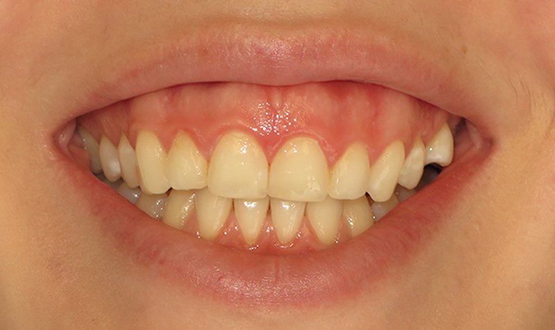 Gummy Smile Cases case 174 — before