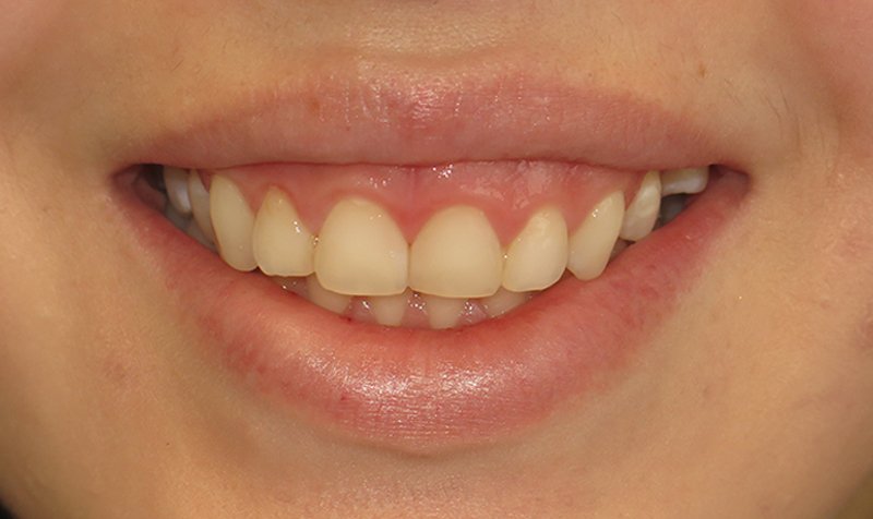 Gummy Smile Cases case 174 — after