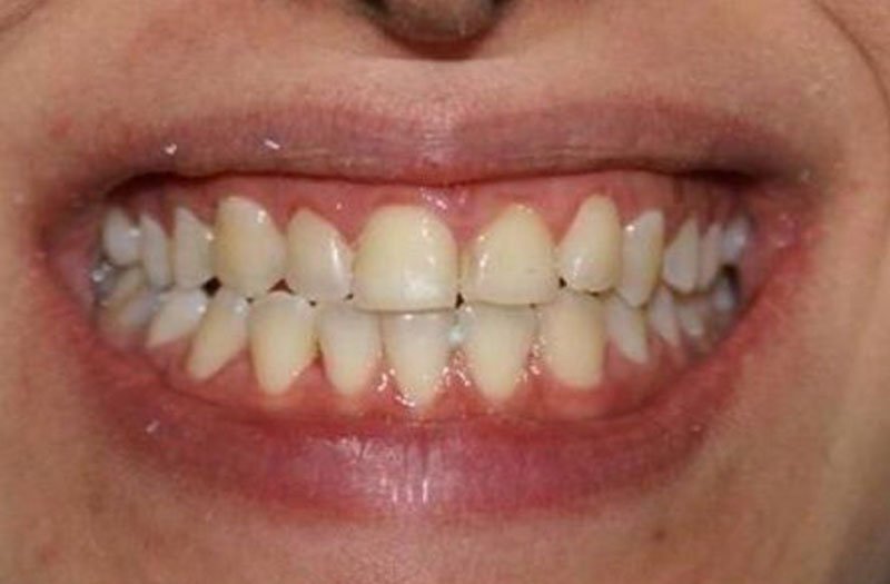 Gummy Smile Cases case 29 — before