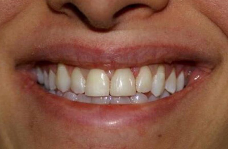 Gummy Smile Cases case 29 — after