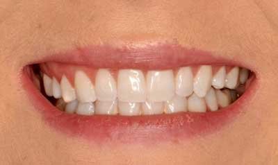 Gummy Smile Cases case 43 — before