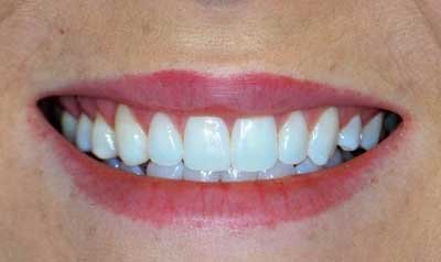 Gummy Smile Cases case 43 — after