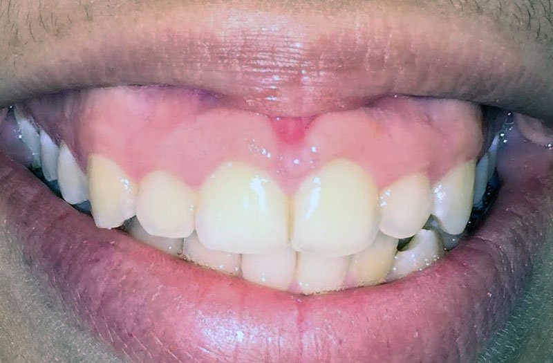Gummy Smile Cases case 47 — before
