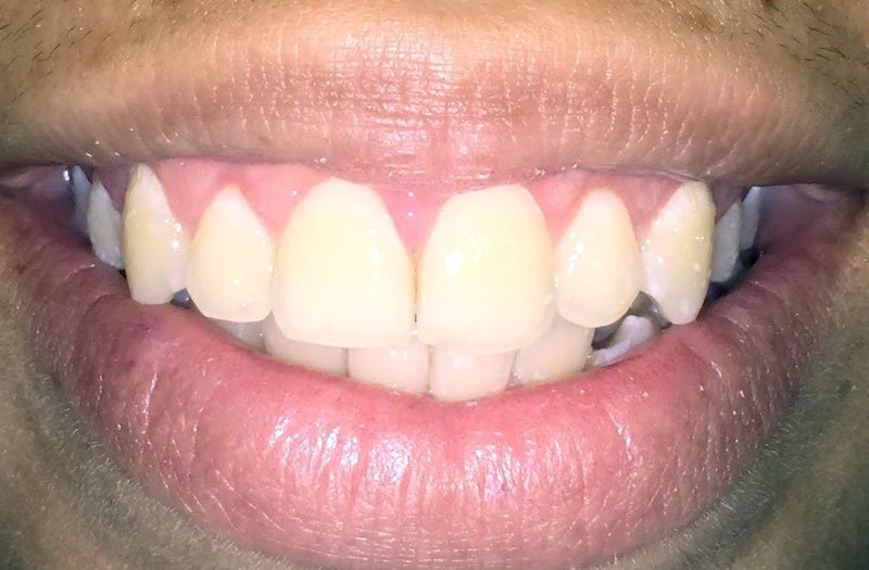 Gummy Smile Cases case 47 — after