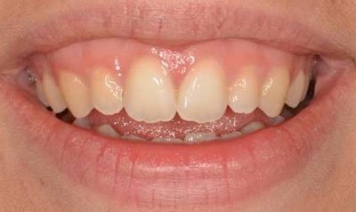 Gummy Smile Cases case 50 — before