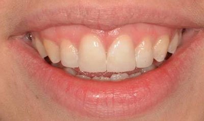 Gummy Smile Cases case 50 — after