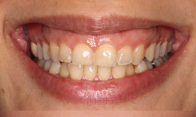 Gummy Smile Cases case 65 — before