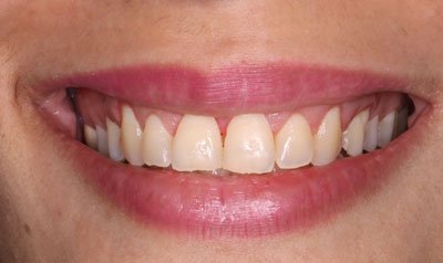 Gummy Smile Cases case 65 — after