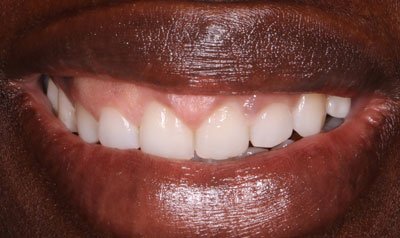 Gummy Smile Cases case 88 — before