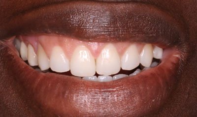 Gummy Smile Cases case 88 — after