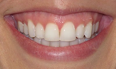 Gummy Smile Cases case 96 — before