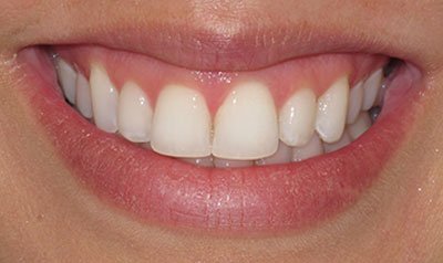 Gummy Smile Cases case 96 — after