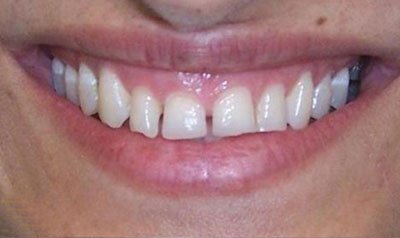 Gummy Smile Cases case 4 — before