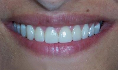 Gummy Smile Cases case 4 — after