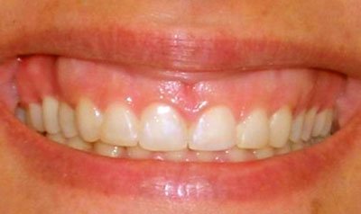 Gummy Smile Cases case 7 — before