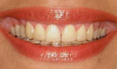 Gummy Smile Cases case 7 — after
