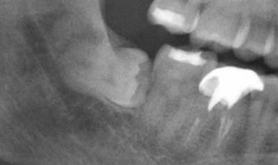 Impacted Wisdom Teeth Removal case 14 — before