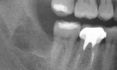 Impacted Wisdom Teeth Removal case 14 — after