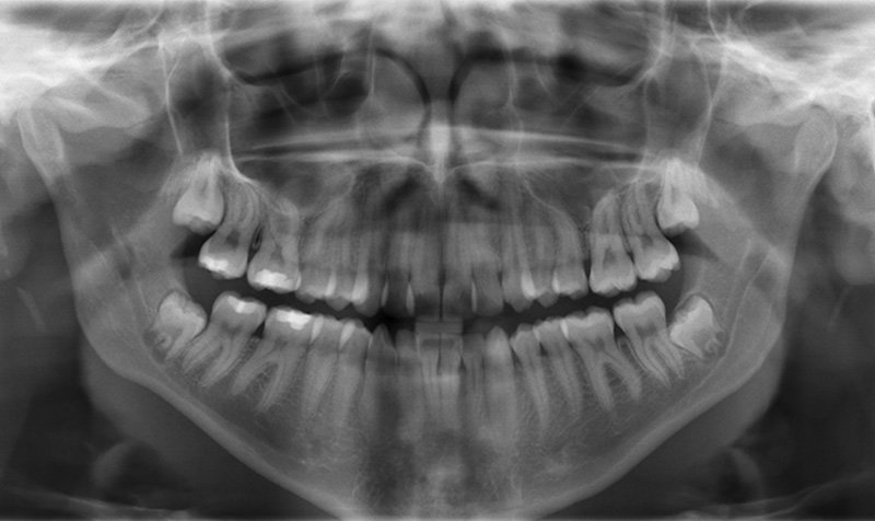 Impacted Wisdom Teeth Removal case 144 — before