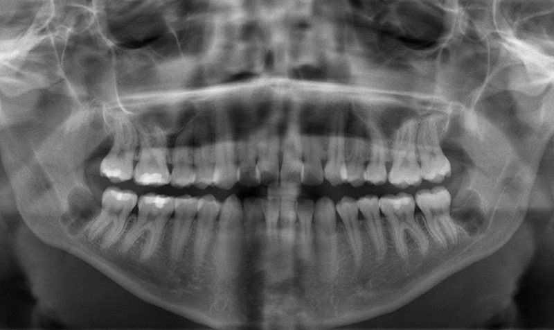 Impacted Wisdom Teeth Removal case 144 — after
