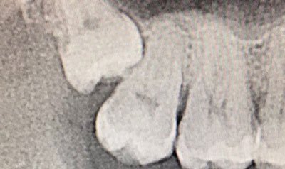 Impacted Wisdom Teeth Removal case 36 — before