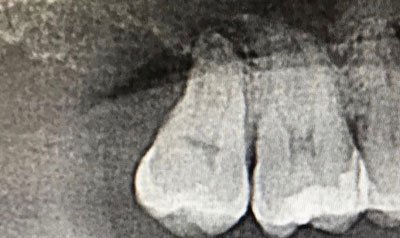 Impacted Wisdom Teeth Removal case 36 — after