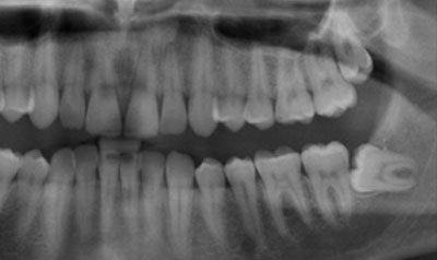Impacted Wisdom Teeth Removal case 57 — before