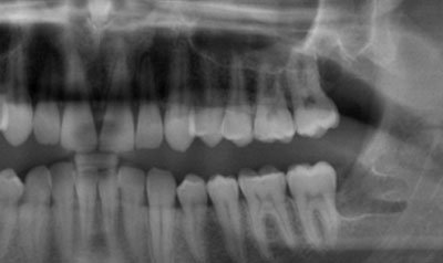 Impacted Wisdom Teeth Removal case 57 — after