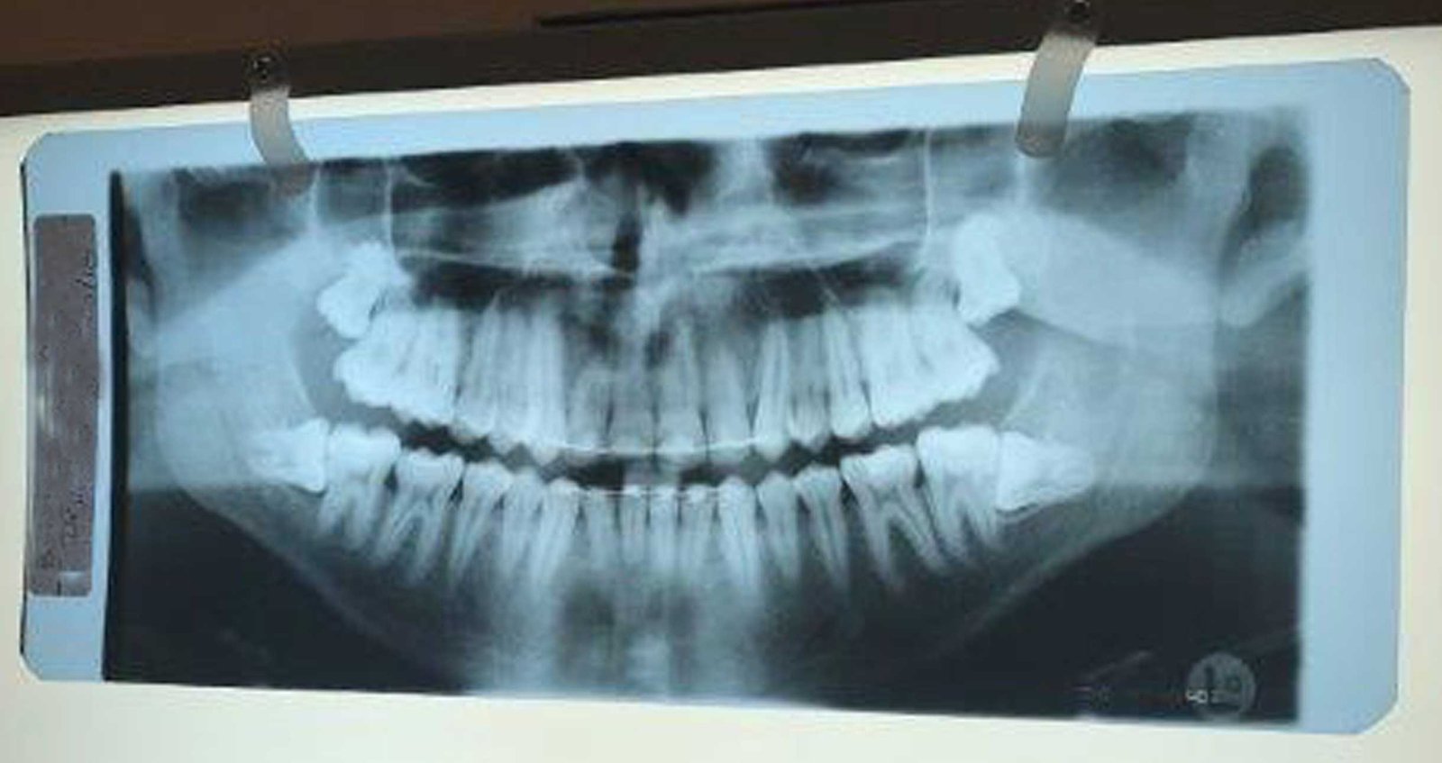 Impacted Wisdom Teeth Removal case 85 — before