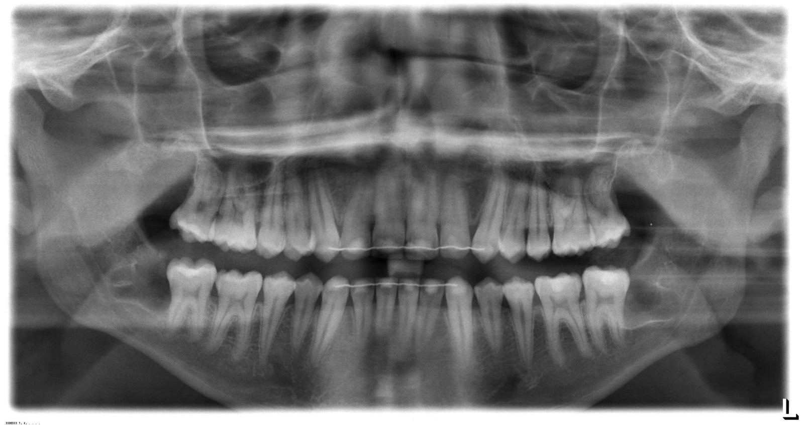 Impacted Wisdom Teeth Removal case 85 — after