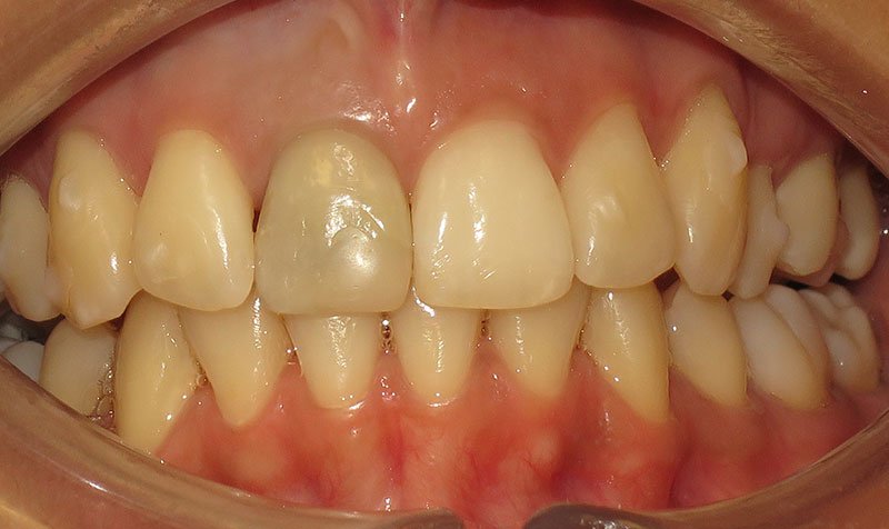Internal Bleaching case 136 — before