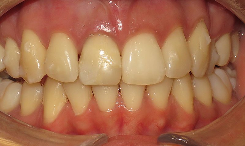 Internal Bleaching case 136 — after