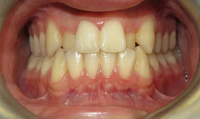 Invisalign Cases case 1 — before