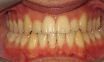 Invisalign Cases case 1 — after