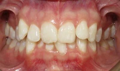 Invisalign Cases case 2 — before