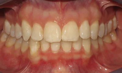 Invisalign Cases case 2 — after