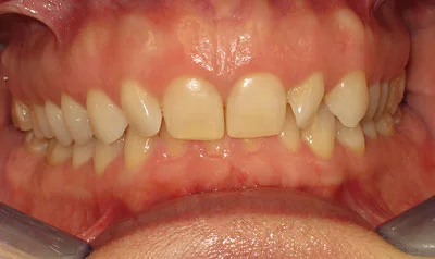 Invisalign Cases case 107 — before